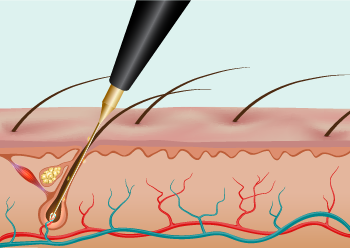 illustration Epil&Care