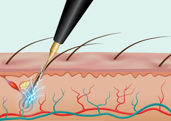 illustration Epil&Care