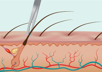 illustration Epil&Care