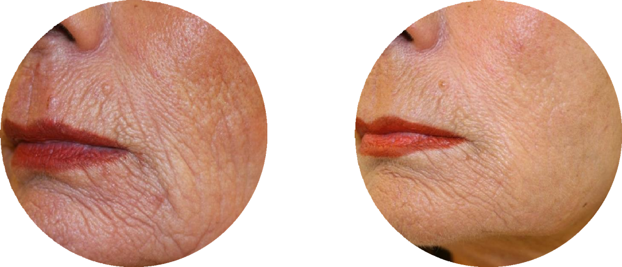 avant/après Dermablate